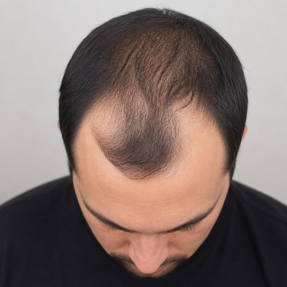 Mesmo homem com o couro aparecendo antes e com a área coberta pelo pigmento depois — antes